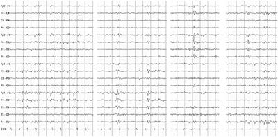 Late-Onset Ictal Asystole and Falls Related to Severe Coronary Artery Stenosis: A Case Report